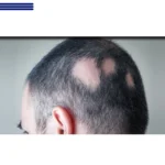 ریزش سکه ای مو