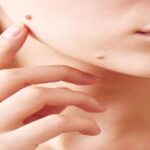 بهترین مرکز برداشتن خال در تهران